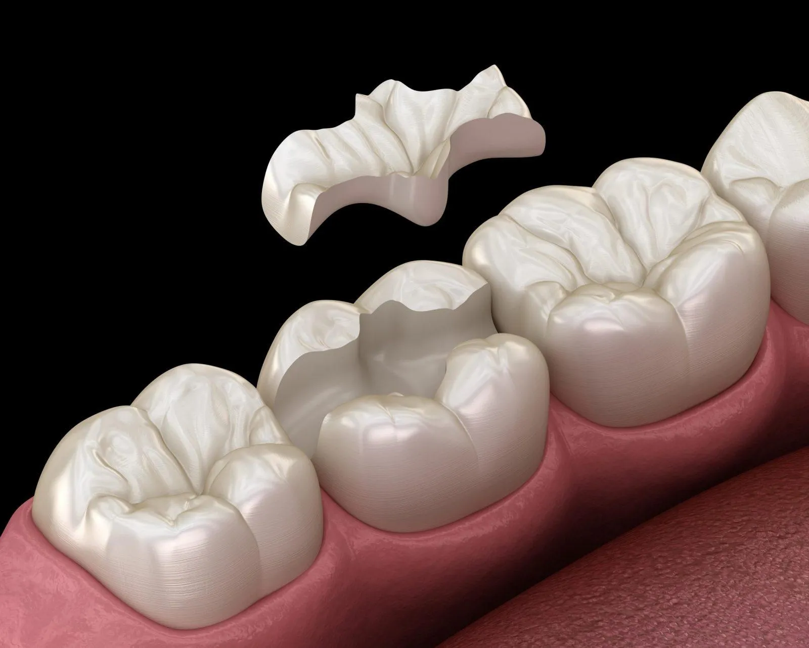 Dental Fillings